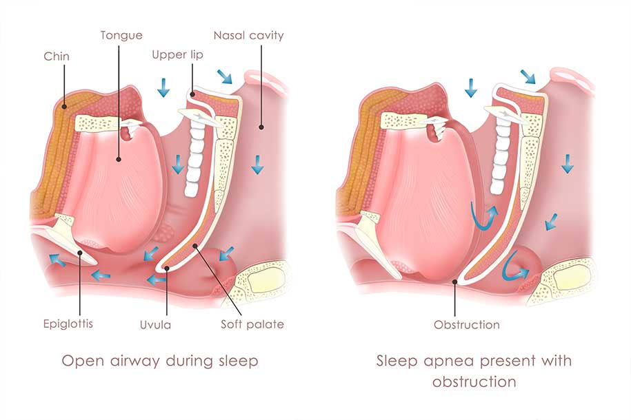 Impact of Treatment for Nasal Cavity Disorders on Sleep Quality