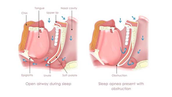 medical-concept-of-obstructive-sleep-apnea-oc-ent-clinic