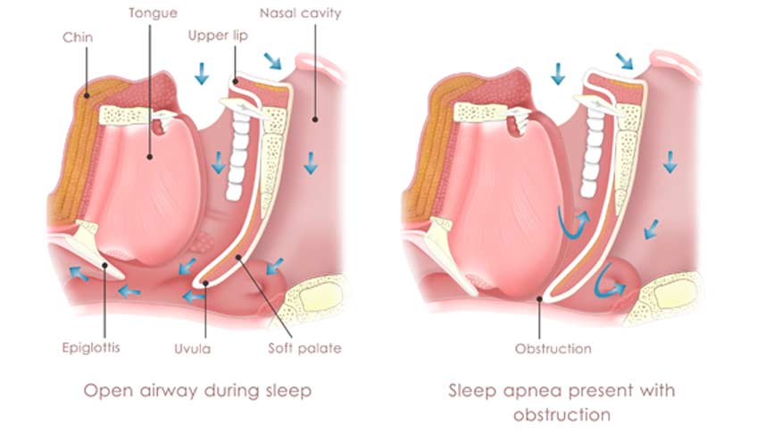 medical-concept-of-obstructive-sleep-apnea-OC-ENT-Clinic