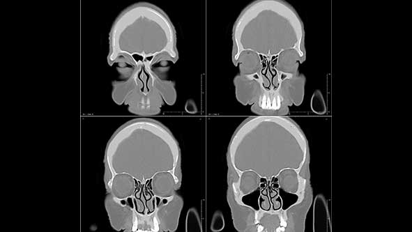 Image-Guided-Sinus-Surgery-Orange-County-ENT-n